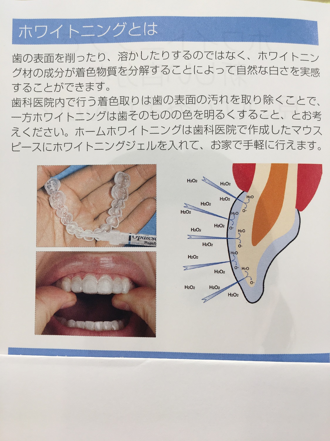 ホワイトニング お試し期間はじまりました