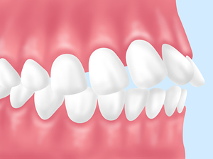 上顎前突（出っ歯）