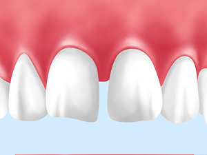 空隙歯列（くうげきしれつ）（すきっ歯）