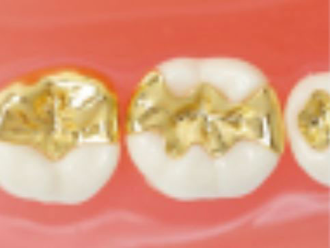 ゴールドインレー小臼歯：32,000円大臼歯：52,000円