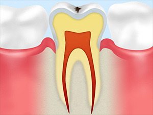 CO　初期のむし歯