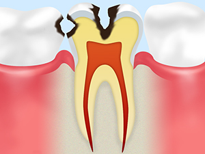 C2　象牙質まで進行したむし歯