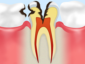 C3　神経にまで進行した虫歯