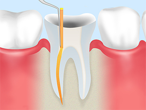 根管治療とは