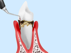 歯周ポケットの検査