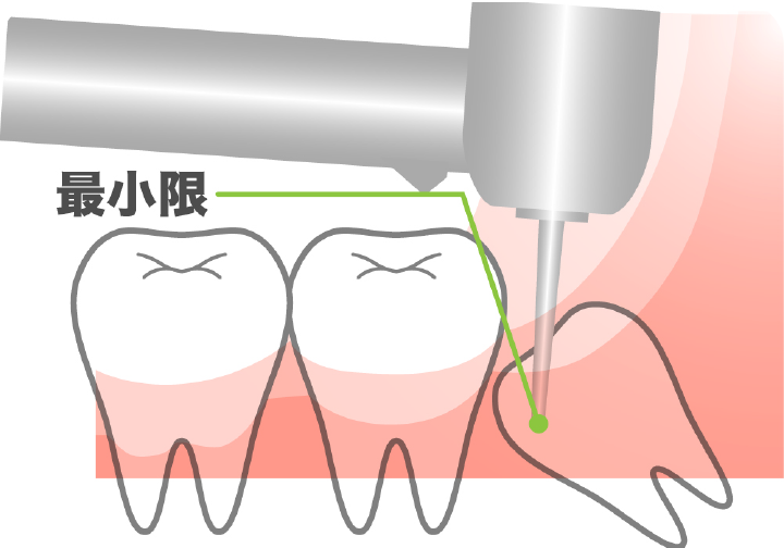 低侵襲処置